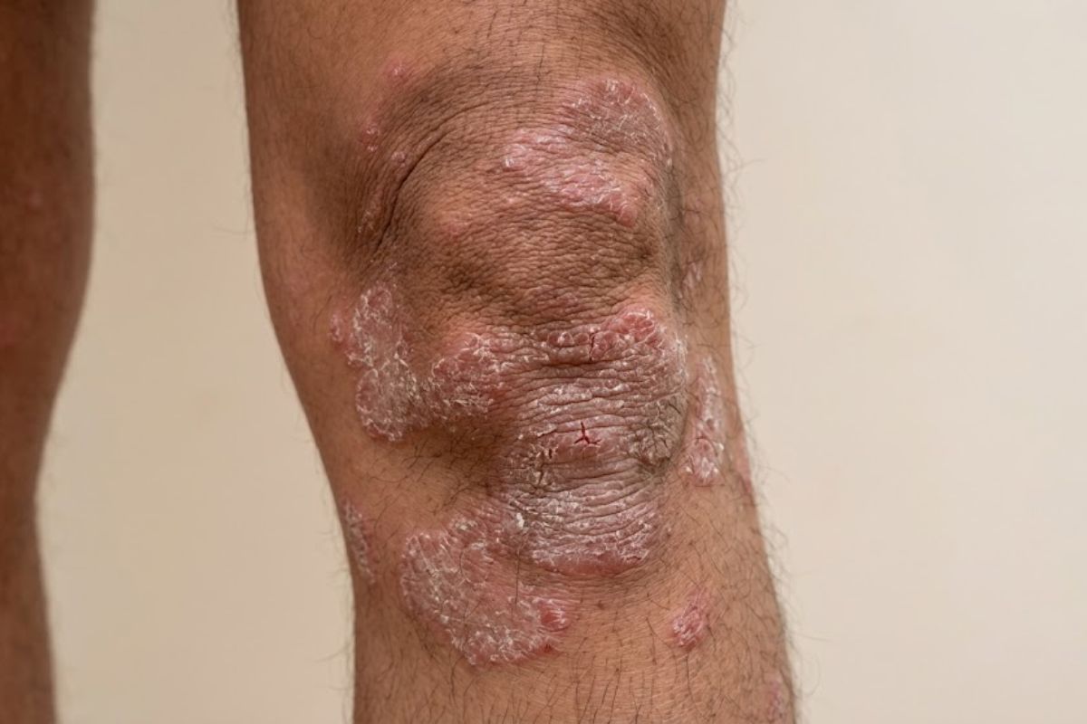 Before treatment